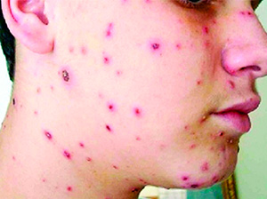 Doenças Infecciosas